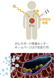 早期がんの治療法として